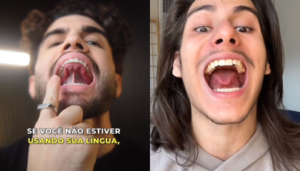 Mewing define o mandíbula? Conheça riscos do exercício viral do TikTok. Foto: Divulgação